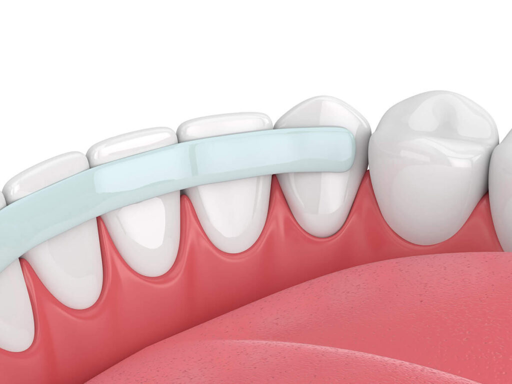 Bottom teeth bonded together from the back of the teeth.