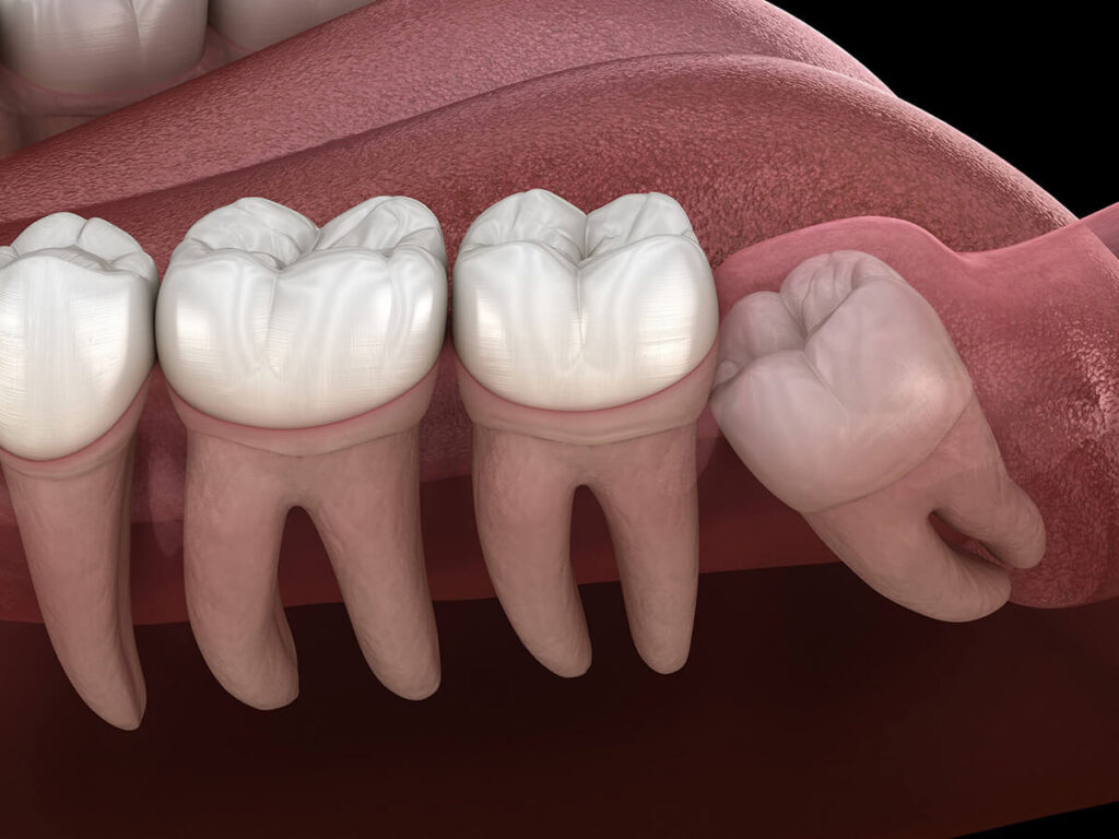 Profile view of a wisdom tooth inside the mouth.